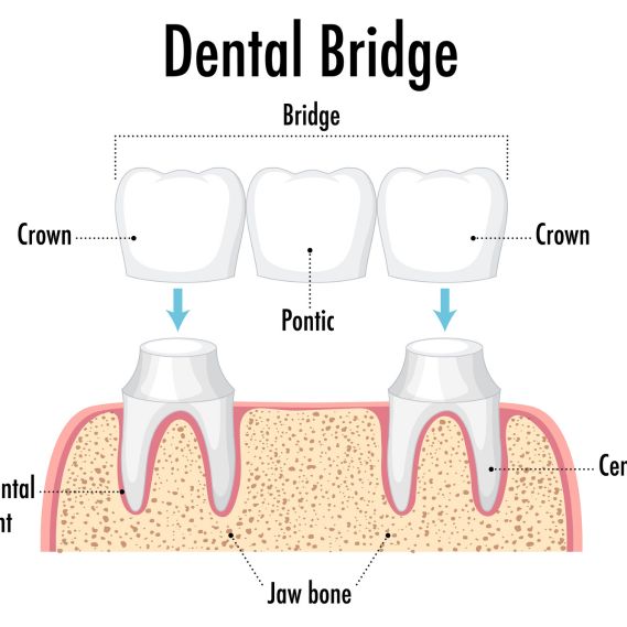 Relaxed patient smiling comfortably during painless dental bridge preparation at Diagnopein